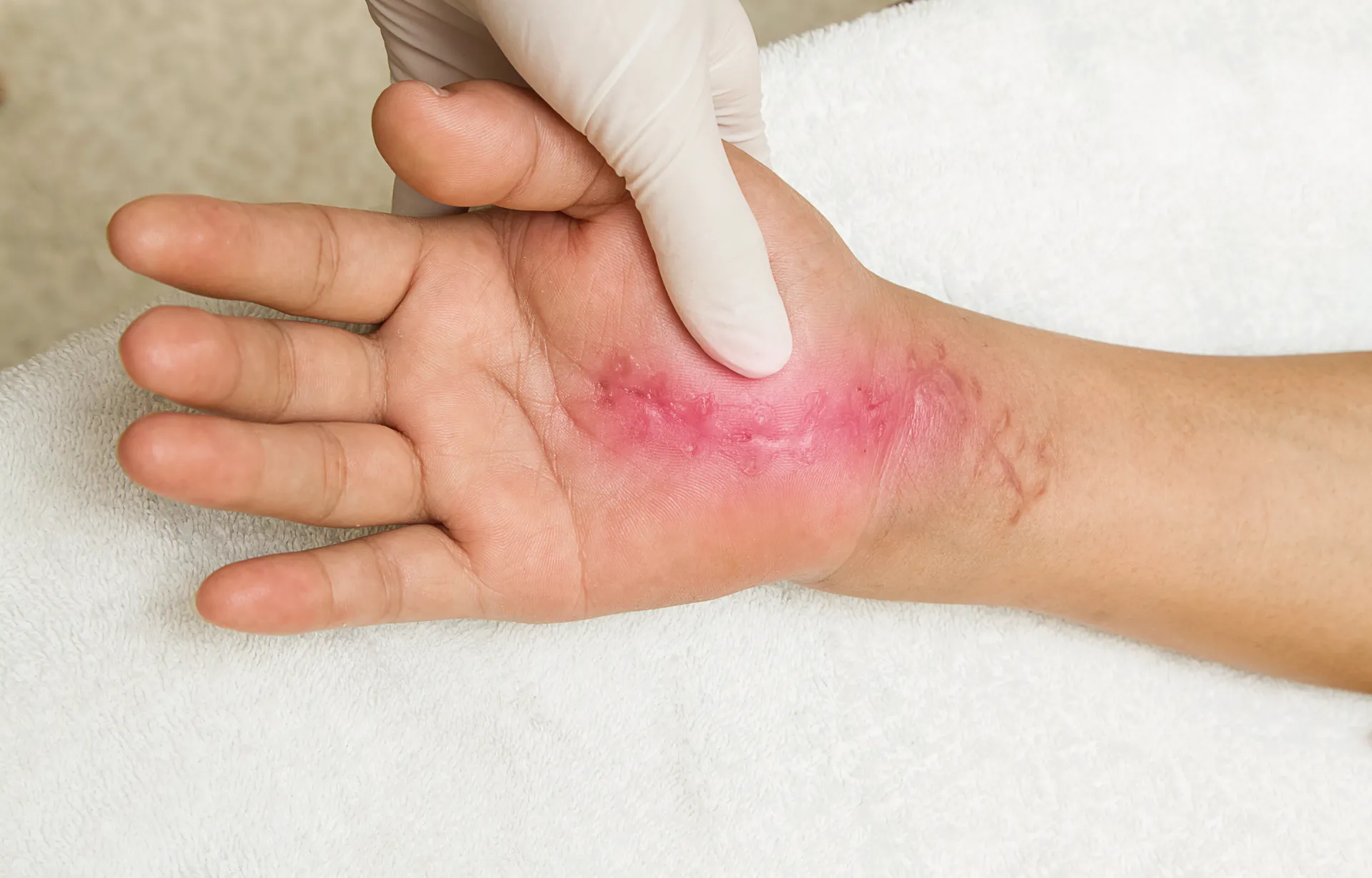 Therapeutische Untersuchung einer gereizten Handfläche